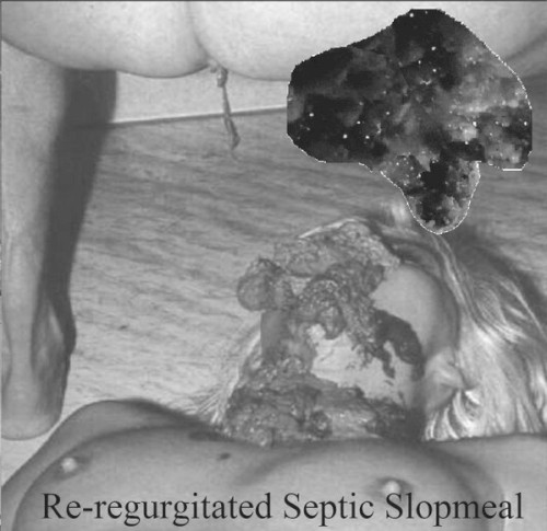 Re-regurgitated Septic Slopmeal