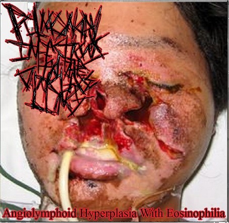 Angiolymphoid Hyperplasia With Eosinophilia