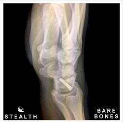 Bare Bones