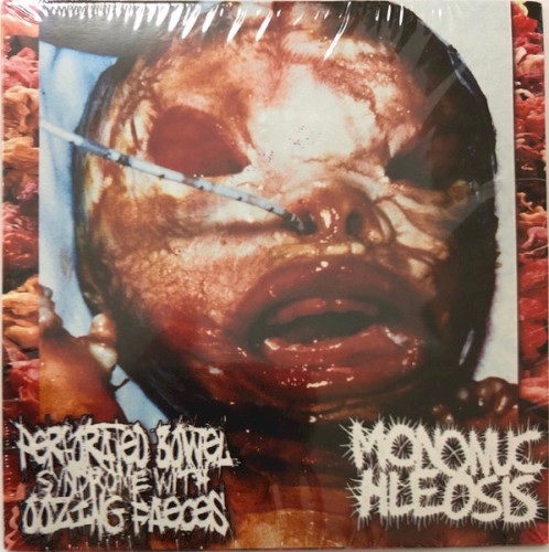 Perforated Bowel Syndrome With Oozing Faeces / Mononuchleosis