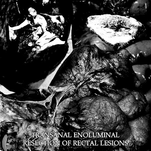 Transanal Enoluminal Resection of Rectal Lesions