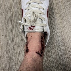 Dogbite