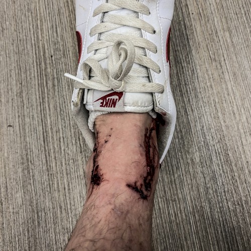 Dogbite