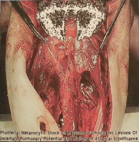 Proliferal Melanocytic Shock Of Recurring Tumorigenic Lesions Of Uncertain Pulmonary Potential And Malignant Atypical Significance