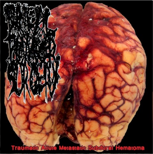 Traumatic Acute Metastatic Subdural Hematoma