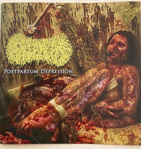 Postpartum Depression