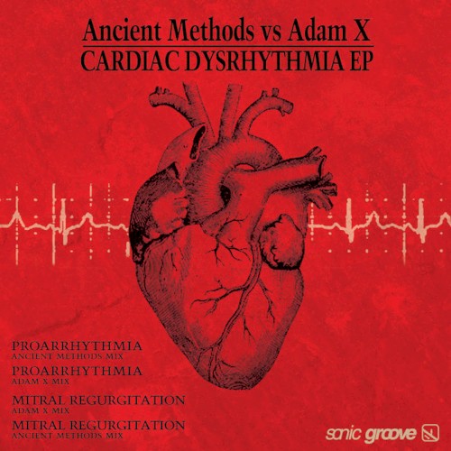 Cardiac Dysrhythmia EP