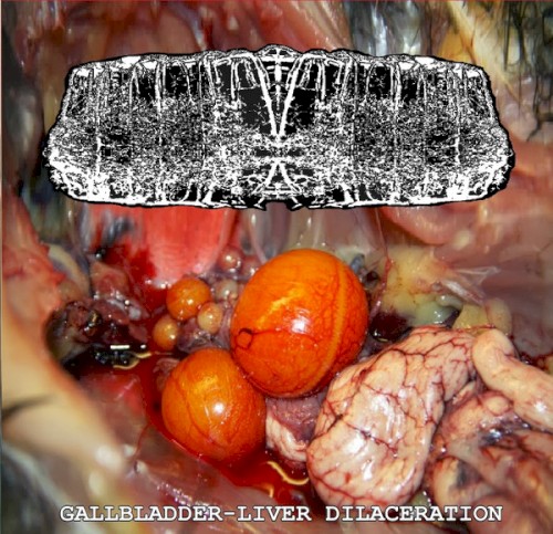 Gallbladder-liver Dilaceration