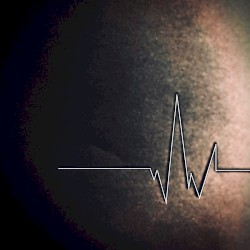 sinus rhythm