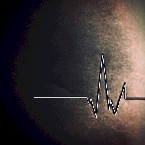 sinus rhythm
