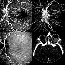 Metastases
