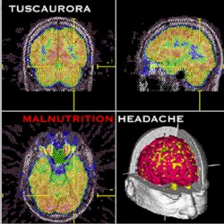 Malnutrition Headache