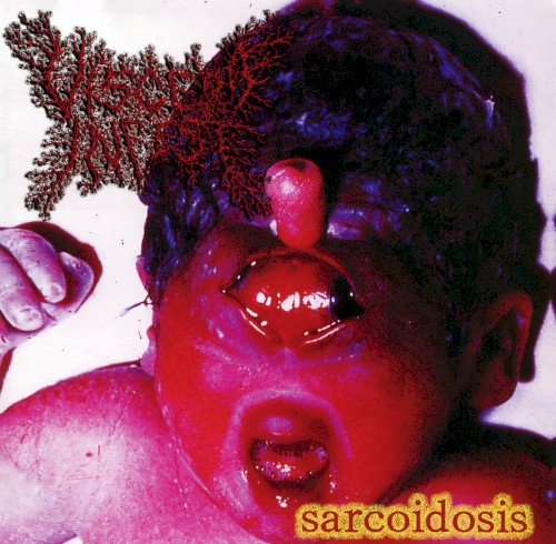 Sarcoidosis