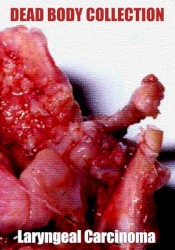 Laryngeal Carcinoma