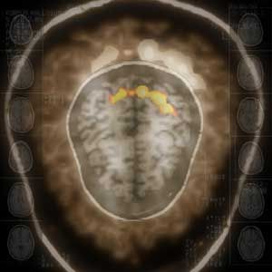 Corpus Callosum