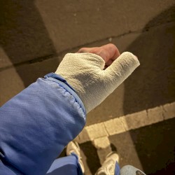 Hand gebrochen
