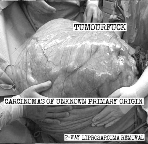 2-way Liprosarcoma Removal