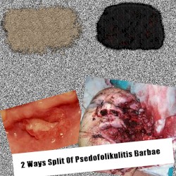 2 Ways Split Of Psedofolikulitis Barbae