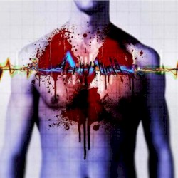 Arrhythmia