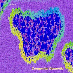 Congenital Dementia