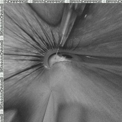 Lobotomy