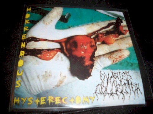 Horrendous Hysterectomy