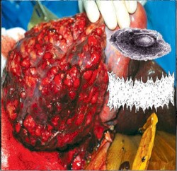 Paraganglioma / Bowel Fermentation