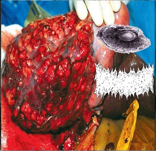 Paraganglioma / Bowel Fermentation
