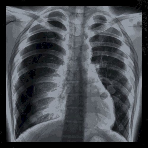Recessions