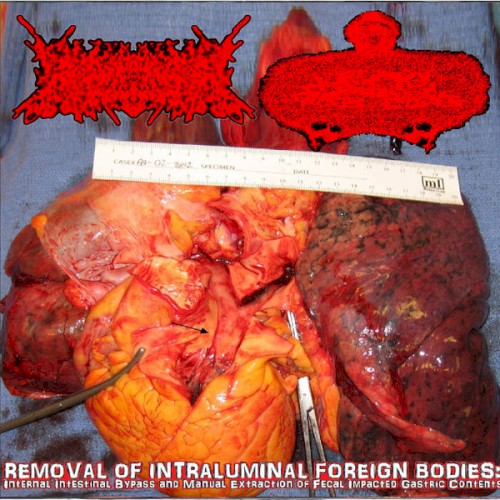 Removal Of Intraluminal Foreign Bodies: Internal Intestinal Bypass And Manual Extraction Of Fecal Impacted Gastric Contents