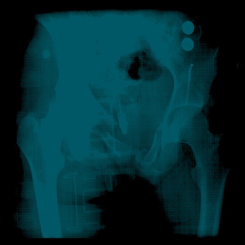 Cracked Pelvis