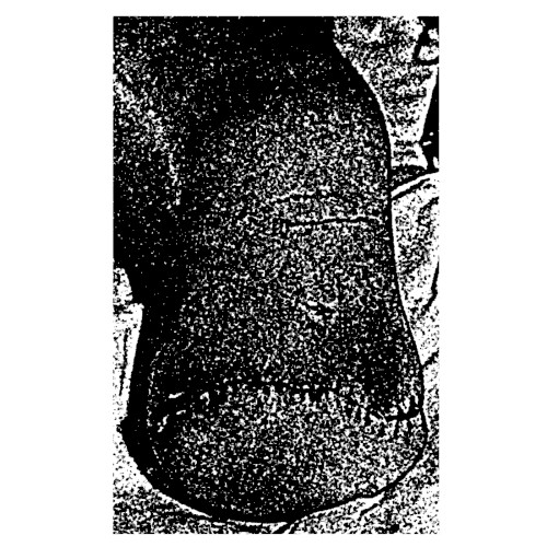 Traumatic Amputations III