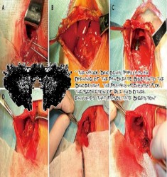 The Major Duodenal Papilla is an Opening of the Pancreatic Duct Into the Duodenum, the Primary Mechanism For the Secretion of Bile and Other Enzymes That Facilitate Digestion