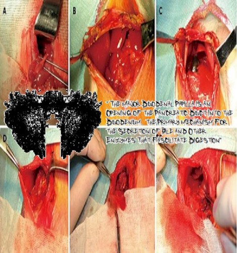 The Major Duodenal Papilla is an Opening of the Pancreatic Duct Into the Duodenum, the Primary Mechanism For the Secretion of Bile and Other Enzymes That Facilitate Digestion