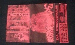 3XA / Hydrocephalus