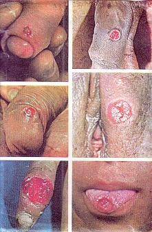 Tumours