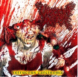 Verrucous Carcinoma