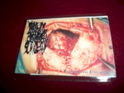 Transfrontal Craniectomy