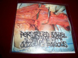 Incomplete Bowelectomy