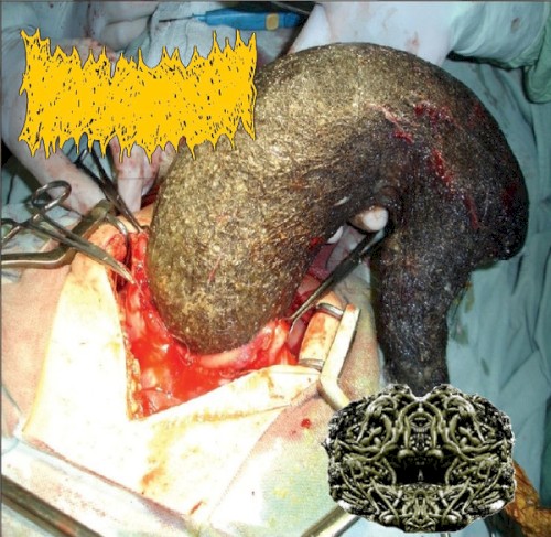 Bowel Fermentation / Lymphatic Filariasis