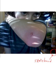 skinned elbow = now you're cool