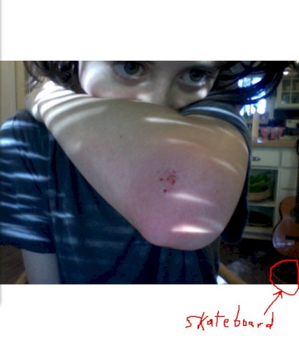 skinned elbow = now you're cool