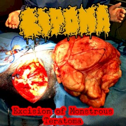 Excision of Monstrous Teratoma