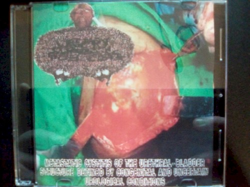 Metastatic Cystitis Of The Urethral-Bladder Structure Defined By Congenital And Uncertain Urological Conditions - Poison Frogs In The Urinary Tract