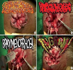 Rectal Fissure Hemorrhoids / Hydrocephalus / Bradymenorrhoea / Ingrown