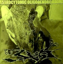 Astrocytomic Oligodendrollioma